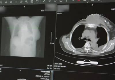 掌乐策略 粒子植入治疗, 将成为癌症患者的新希望!